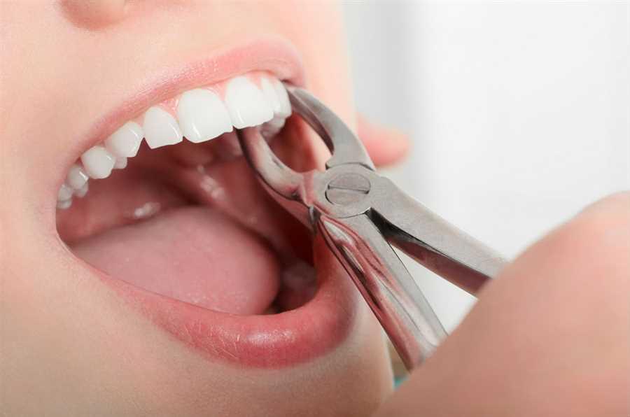 Product: Tooth Extraction - Absolute Dental ®