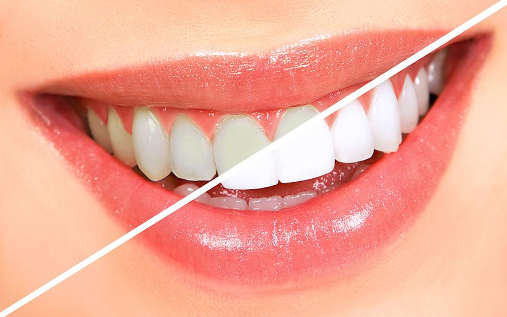 Product: Teeth Whitening - Absolute Dental ®