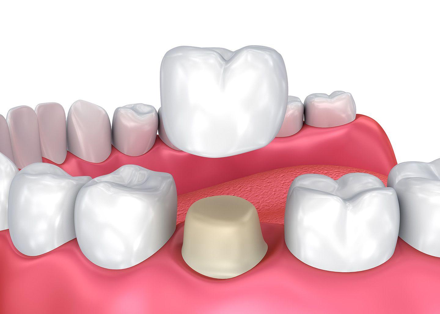 Product: Prosthodontics - Absolute Dental ®