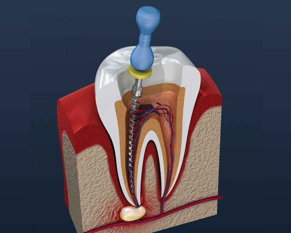 Product: Endodontics - Absolute Dental ®