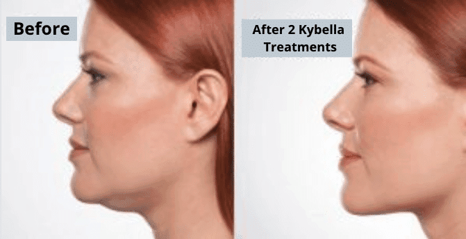 Product Kybella - Non-Surgical Double Chin Treatment | Dr. Vagotis image