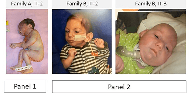 Product Bi-allelic PAGR1 variants are associated with microcephaly and a severe neurodevelopmental disorder: Genetic evidence from two families » Geneyx image