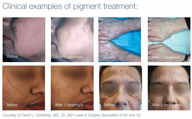 Product Tattoo Removal and Pigment Removal in Jupiter, FL | Jupiter Dermatology & Hair Restoration image