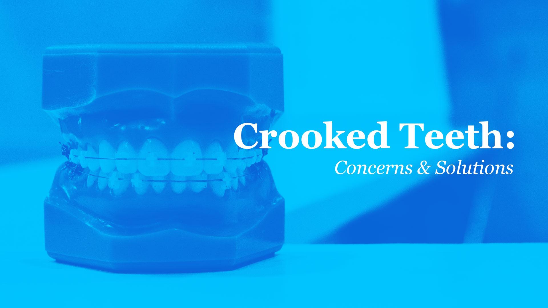Product: Crooked Teeth: Concerns and Solutions - Shine Modern Dentistry