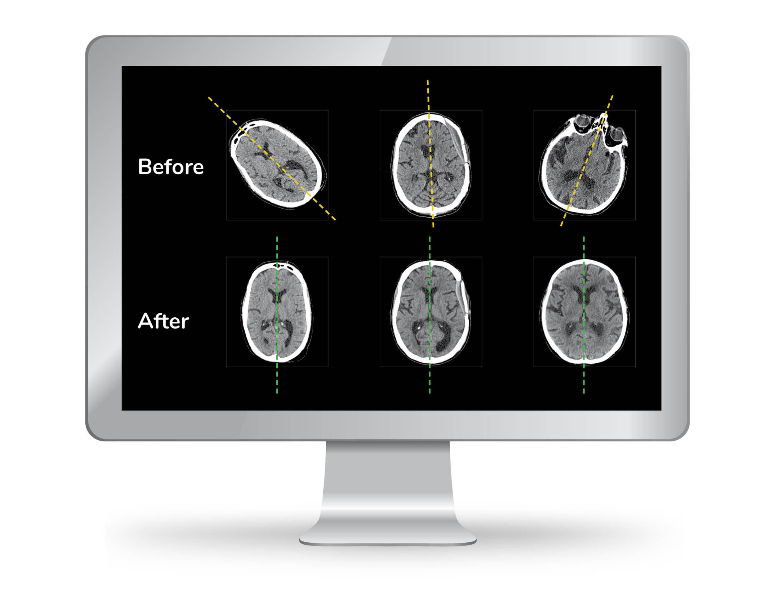 Product NeuroQuant CT - Cortechs.ai image