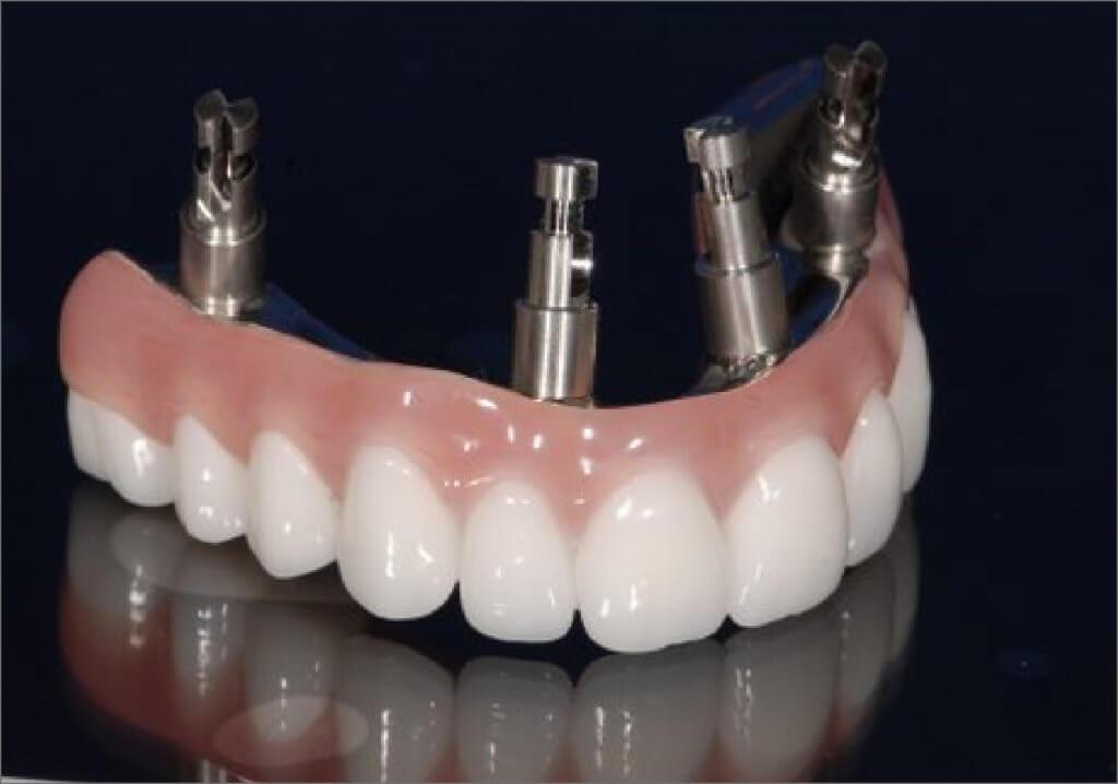 Product Arizona Denture Labs - Implant Supported Denture Restorations image